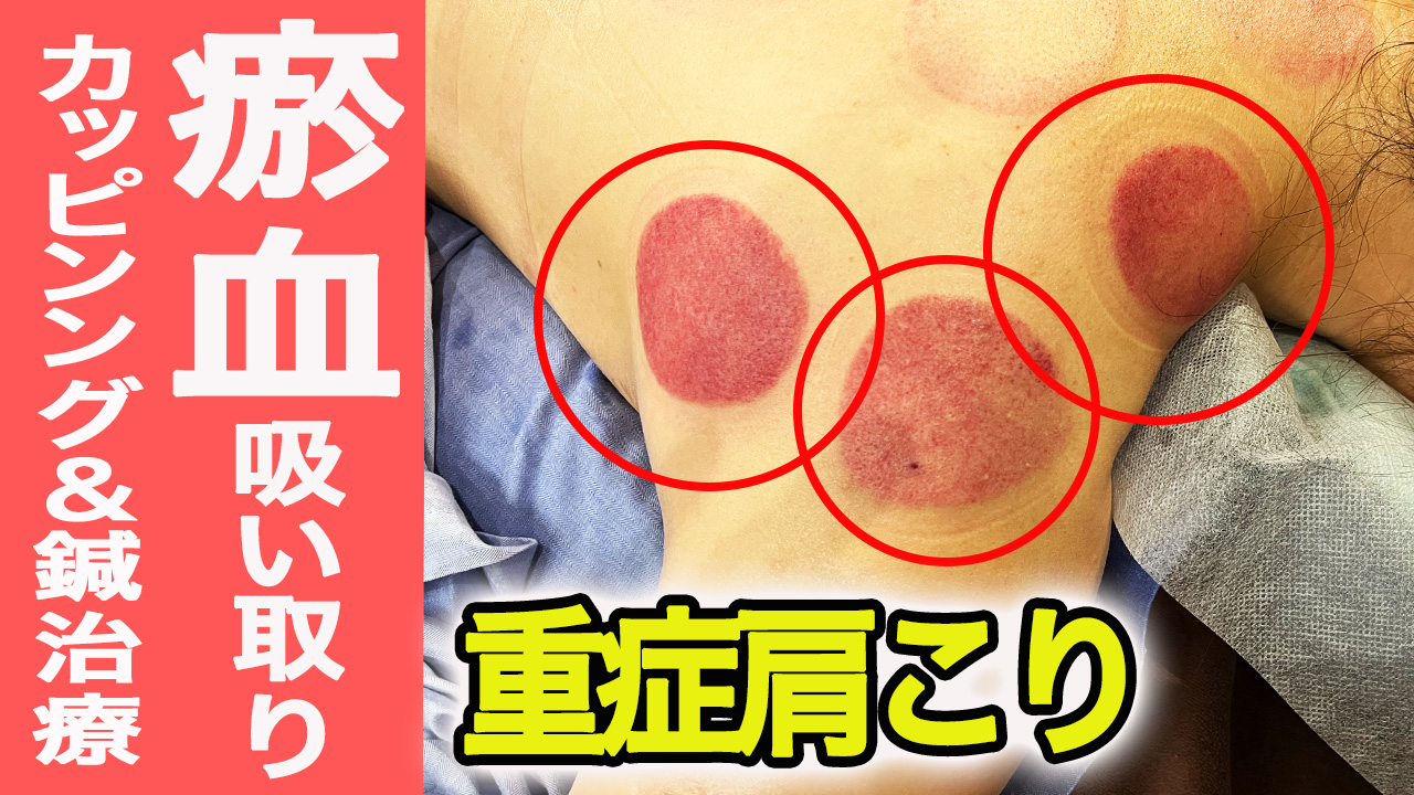 肩こりに対するカッピング施術のYouTube動画