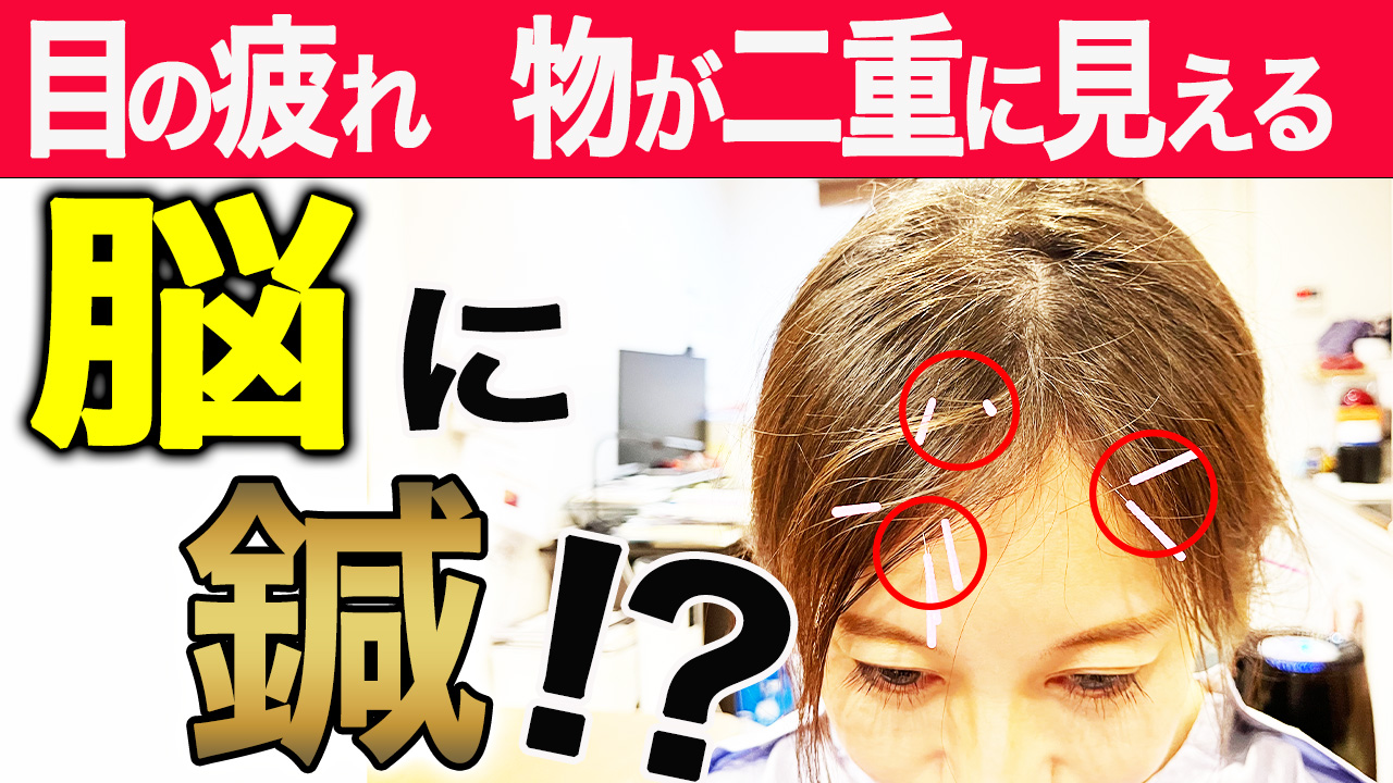 YNSAによる頭皮鍼施術を紹介するYouTube動画